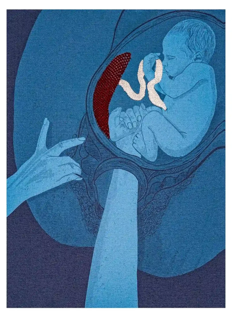 Ilustración digital impresa sobre lienzo e intervenida con bordado. La imagen retrata una bebe siendo extraído violentamente del vientre matero.